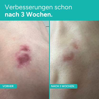 Glim Skin GLIM90 bei Narben & Wunden